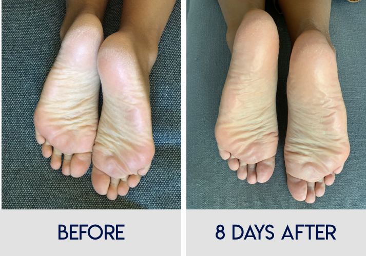how do foot peels work: an 8-day journal